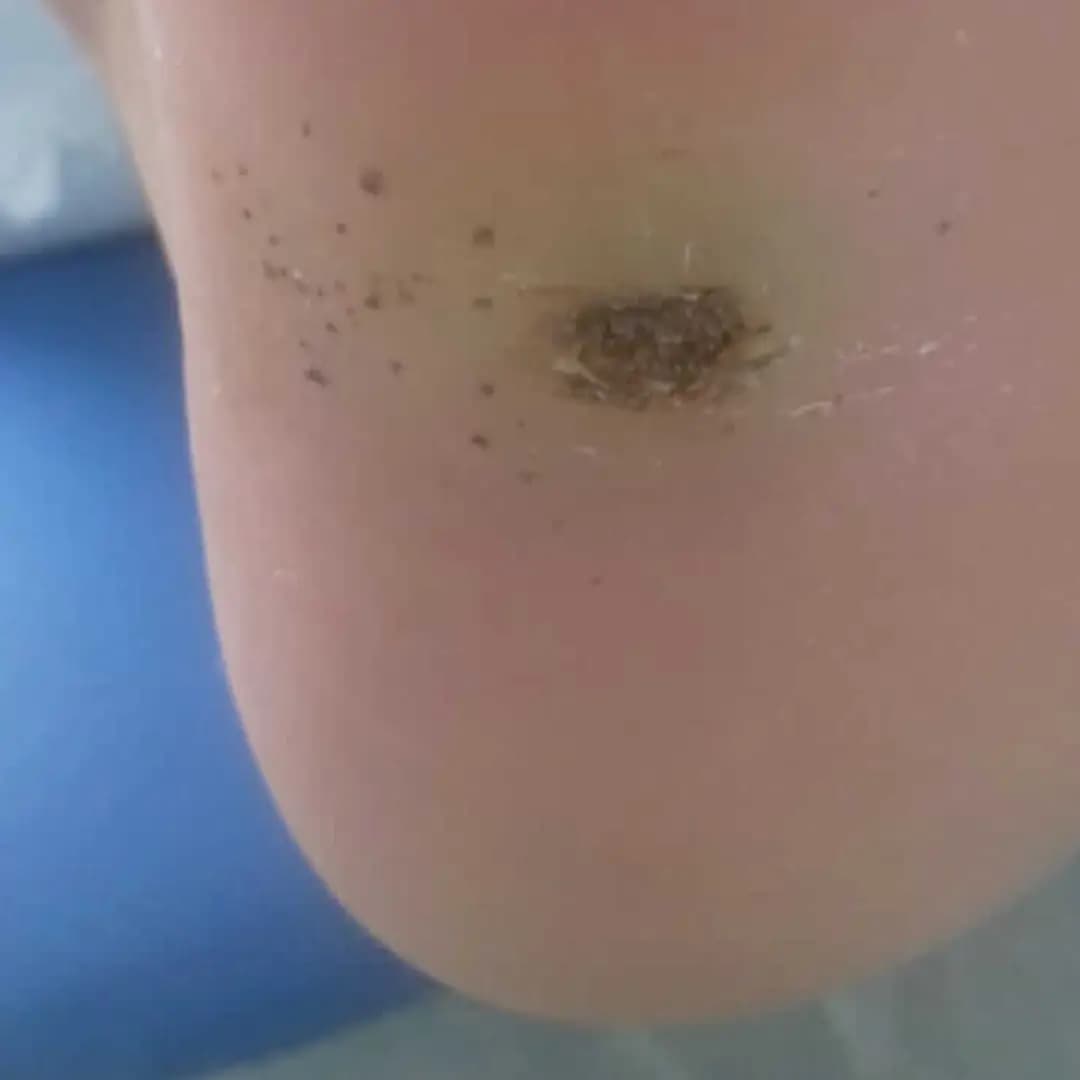 Área circular de pele espessada na planta do pé